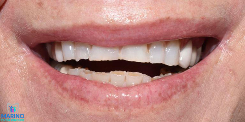 Tooth Restoration Dentist Greater Jacksonville Florida